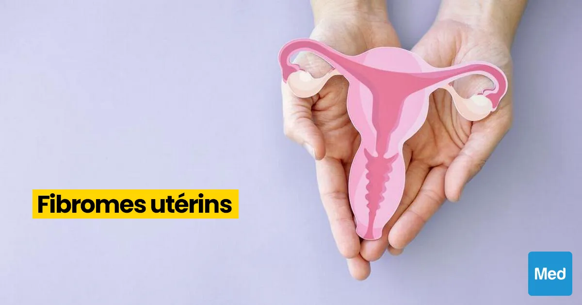 Fibromes utérins : définition, symptômes, diagnostic et traitement